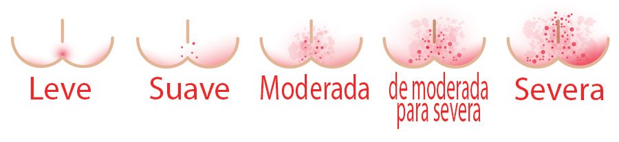 tipos de assaduras em bebê