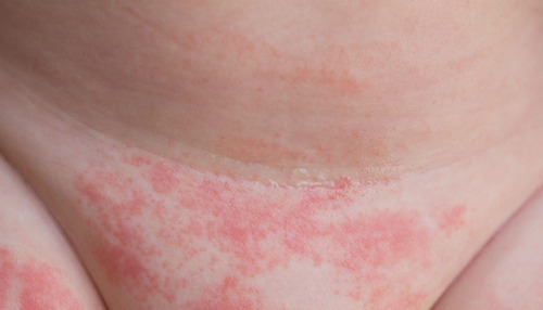 pomada para assaduras de bebê